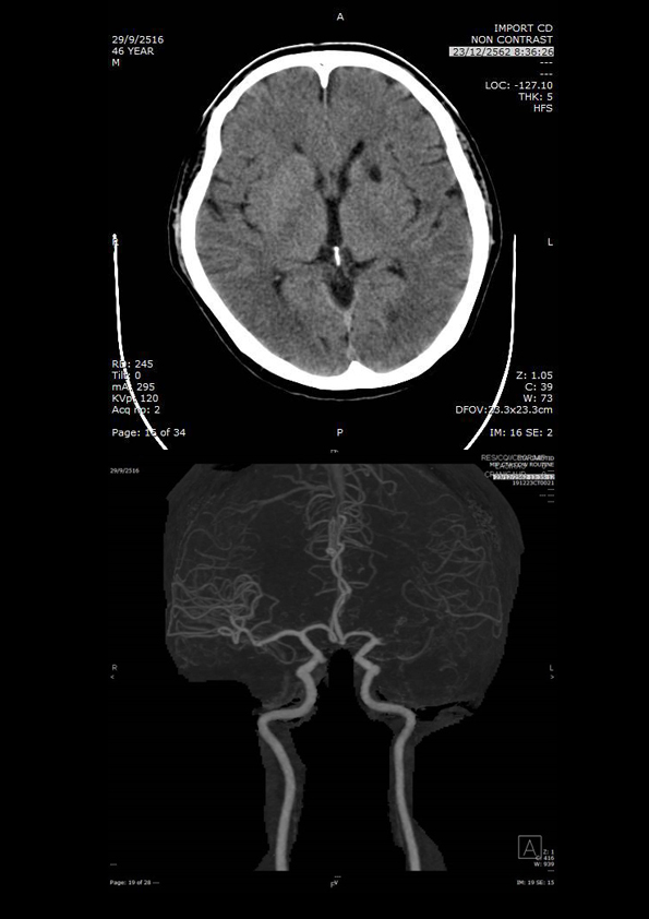 Endovascular Treatment for Large Arterial Ischemic Stroke in Thailand at Present and Future